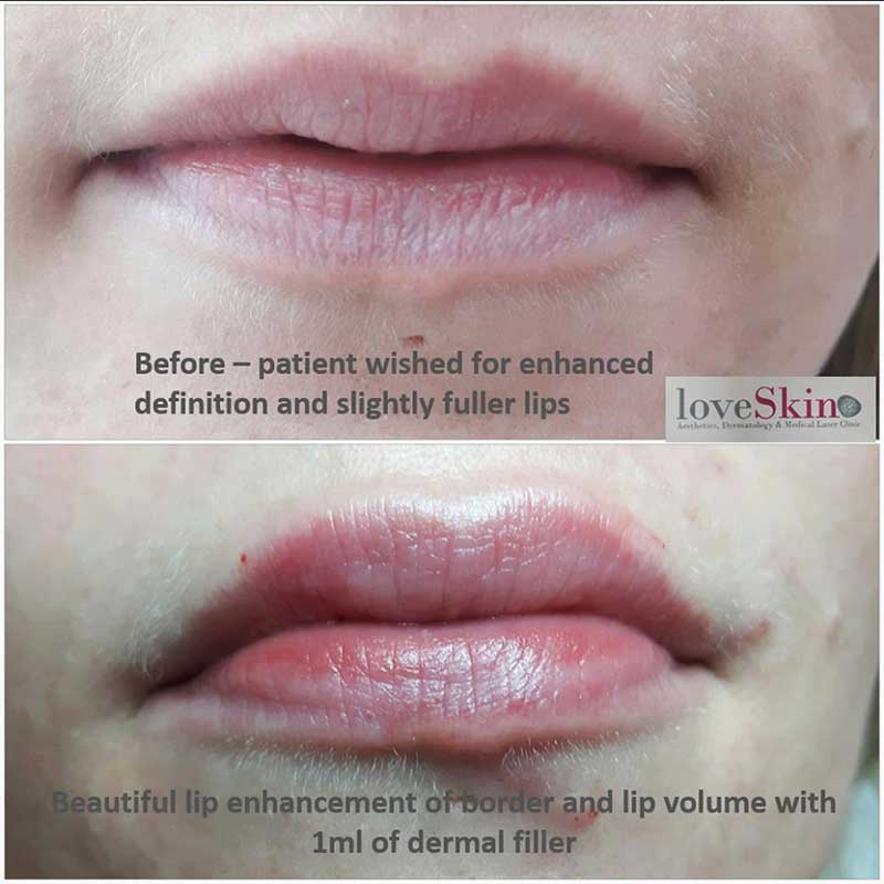 Dermal Filler - Lips