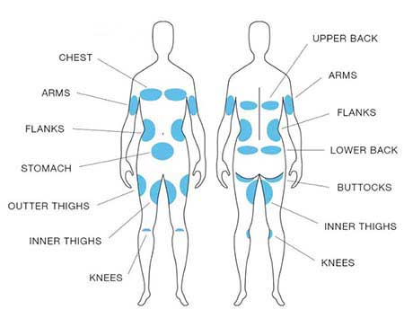 ProShock Ice™ Treatment Areas