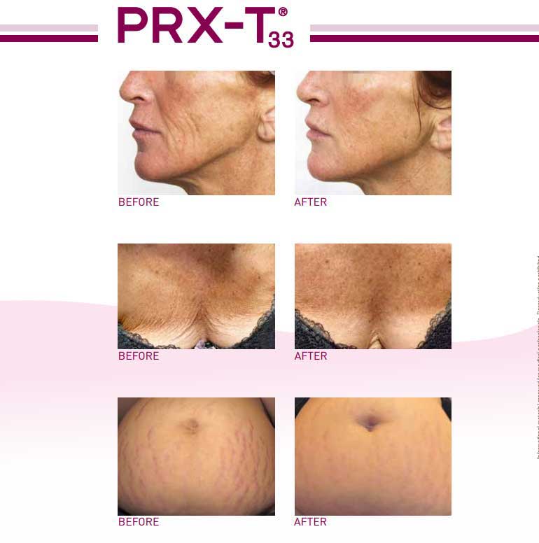 PRX-T33® before and after images