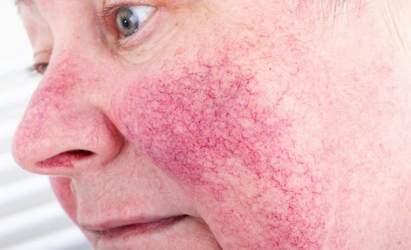 Rosacea