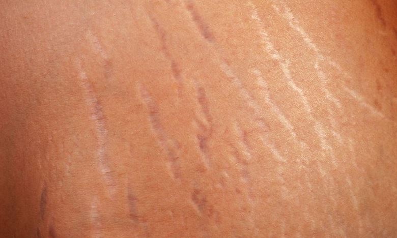Treatments for Stretch Marks