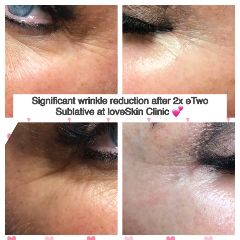 eTwo Sublative Significant Wrinkle Reduction